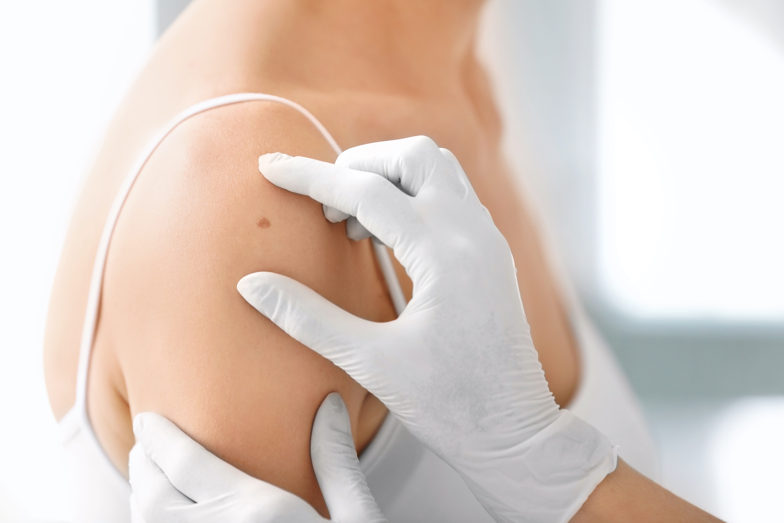 Dermatologist examining birthmark of patient, closeup. Cancer concept